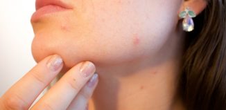 femeie care sufera de acnee